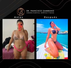 Lipoescultura - Dr. Francisco Zambrano