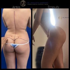 Liposucción -Dr. Francisco Zambrano