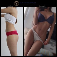 Liposucción - Dr. Francisco Zambrano