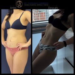 Liposucción - Dr. Francisco Zambrano
