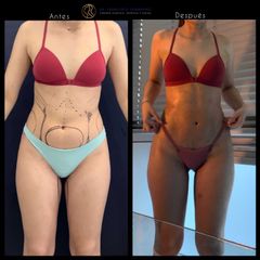 Liposucción - Dr. Francisco Zambrano