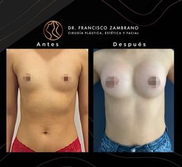 Mamoplastia de Aumento - Dr. Francisco Zambrano
