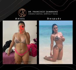 Liposucción - Dr. Francisco Zambrano