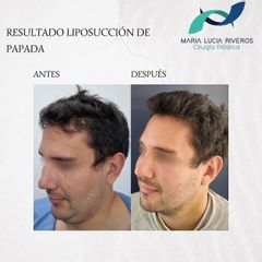Cirugía de papada - Dra. María Lucia Riveros Rueda