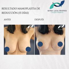 Mamoplastia de reducción - Dra. María Lucia Riveros Rueda