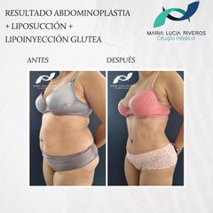 Abdominoplastia - Dra. María Lucia Riveros Rueda