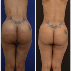 Gluteoplastia - American Plastic