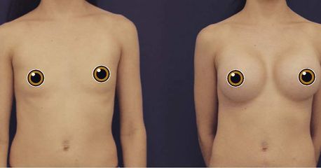 Mamoplastia de aumento  - American Plastic