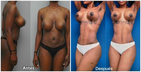 Lipoescultura - Dr. Edgar Ismael Vergara y Dra Judith Cadavid.