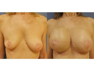 Reconstruction mammaire - Dr Fabrice Poirier