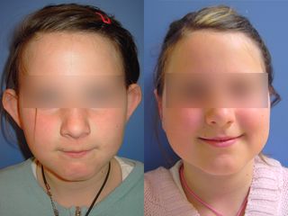 Otoplastie - Dr Fabrice Poirier