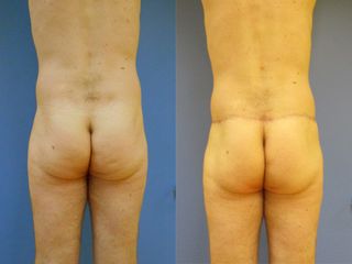 Chirurgie des fesses - Dr Fabrice Poirier