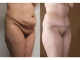 Abdominoplastie - Dr Fabrice Poirier