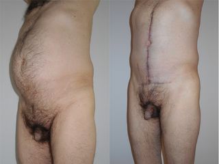Abdominoplastie - Dr Fabrice Poirier 