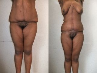 Abdominoplastie - Dr Fabrice Poirier