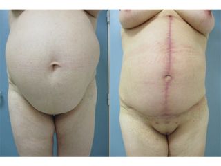 Abdominoplastie - Dr Fabrice Poirier