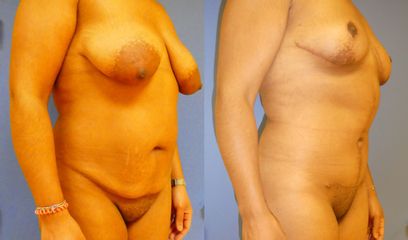 Liposuccion - Dr Fabrice Poirier