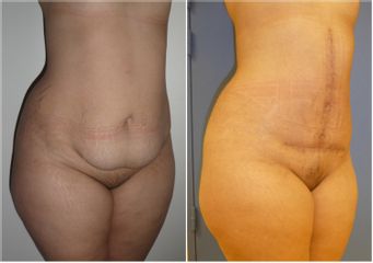 Abdominoplastie - Dr Fabrice Poirier