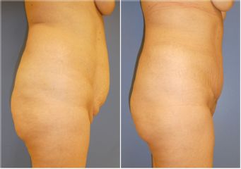 Abdominoplastie - Dr Fabrice Poirier