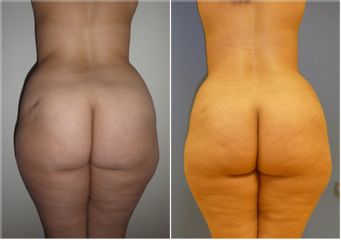 Abdominoplastie - Dr Fabrice Poirier