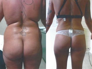 Liposuccion - Dr Luc Vanrenterghem