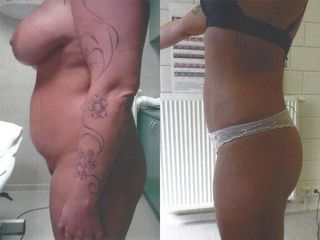 Liposuccion - Dr Luc Vanrenterghem
