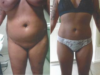 Liposuccion - Dr Luc Vanrenterghem