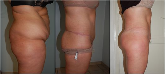 Bodylift - Dr Luc Vanrenterghem