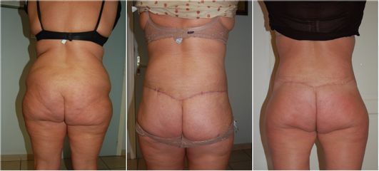 Bodylift - Dr Luc Vanrenterghem