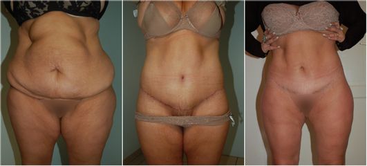 Bodylift - Dr Luc Vanrenterghem