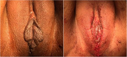 Vaginoplastie - Dr Luc Vanrenterghem