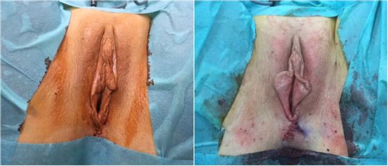 Vaginoplastie - Dr Luc Vanrenterghem