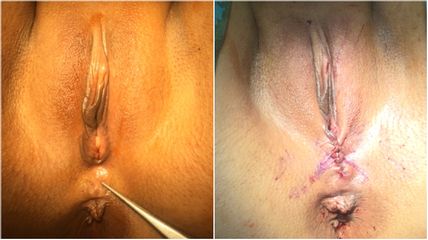 Vaginoplastie - Dr Luc Vanrenterghem