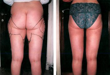 Liposuccion - Dr Luc Vanrenterghem
