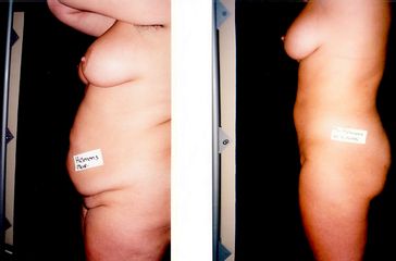 Liposuccion - Dr Luc Vanrenterghem
