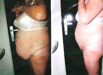 Liposuccion - Dr Luc Vanrenterghem