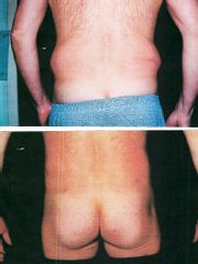 Liposuccion - Dr Luc Vanrenterghem