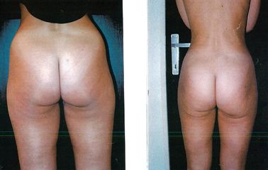 Liposuccion - Dr Luc Vanrenterghem