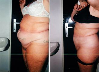 Liposuccion - Dr Luc Vanrenterghem