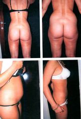 Liposuccion - Dr Luc Vanrenterghem
