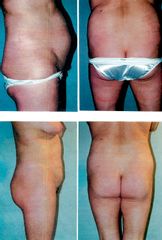 Liposuccion - Dr Luc Vanrenterghem