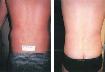 Liposuccion - Dr Luc Vanrenterghem