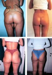 Liposuccion - Dr Luc Vanrenterghem