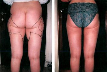 Liposuccion - Dr Luc Vanrenterghem