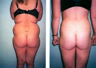 Liposuccion - Dr Luc Vanrenterghem