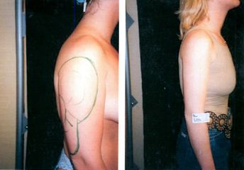 Liposuccion - Dr Luc Vanrenterghem