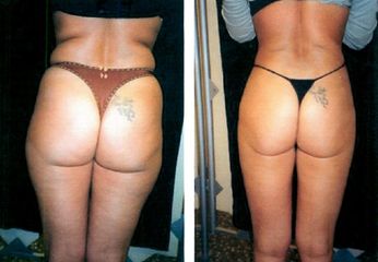 Liposuccion - Dr Luc Vanrenterghem