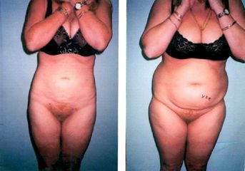 Liposuccion - Dr Luc Vanrenterghem