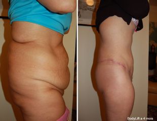 Bodylift - Dr Luc Vanrenterghem