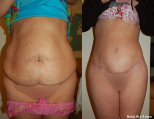 Bodylift - Dr Luc Vanrenterghem